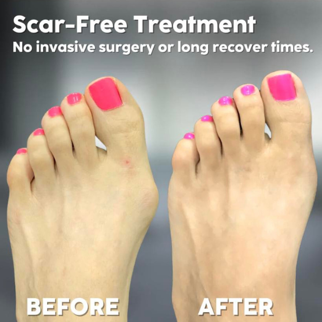 OrthoCare™ - Bunion Relief & Toe Corrector