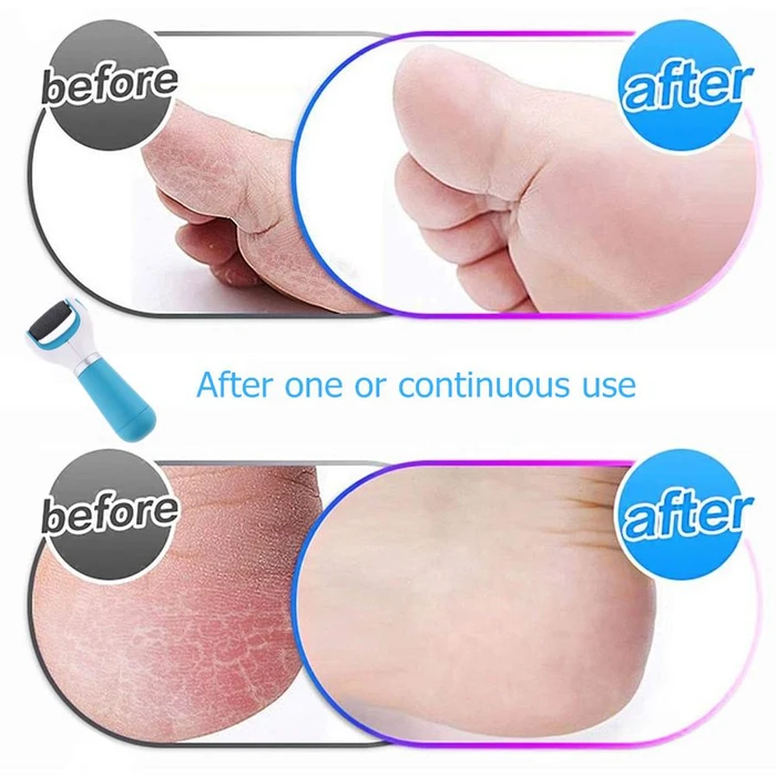 Electric Foot Callus Remover